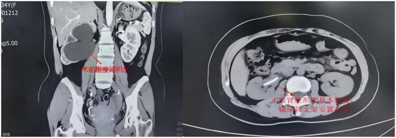 党员先锋勇担当,多科协作护安康 —— 第十三党支部多学科合力攻克复杂妇科泌尿重症(图1) 图片拼1.png